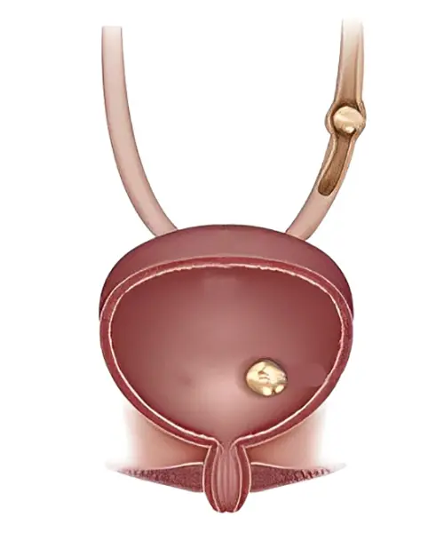 Bladder Stones: Expert Strategies for Prevention and Relief