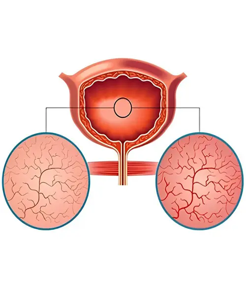 Interstitial Cystitis: Navigating Chronic Bladder Sensitivity