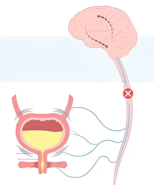 Neurogenic Bladder: Managing Nerve-Related Urinary Dysfunction